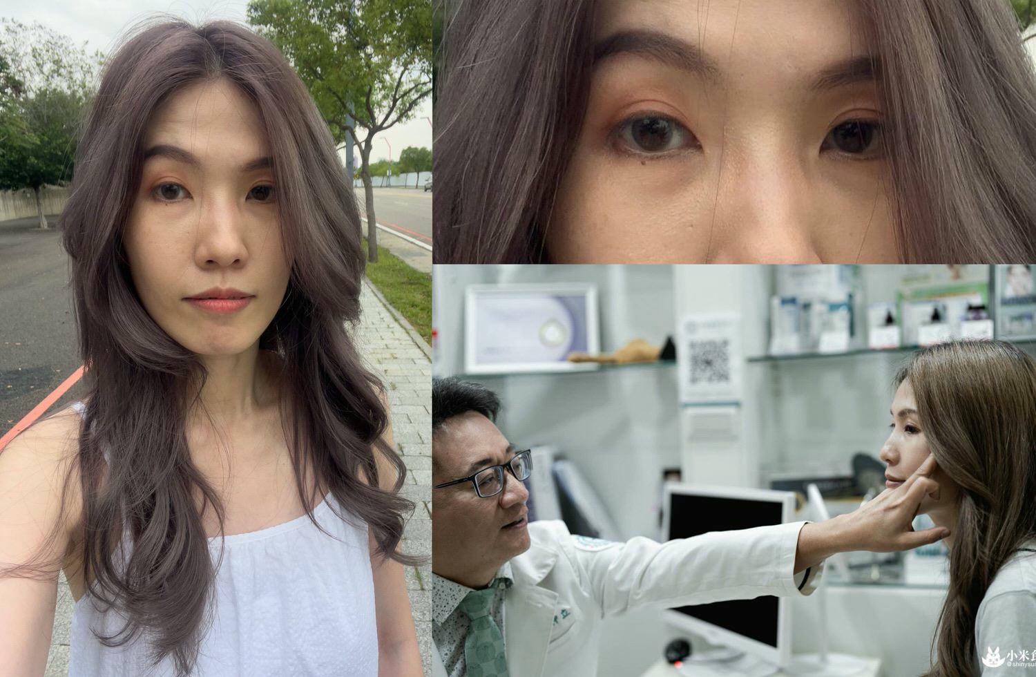 想要改善黑眼圈,醫美推薦-双美膠原蛋白植入劑(熊貓針)心得分享|高雄仲夏醫美診所 - 第2張圖